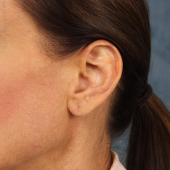 Ear Lobe Lift for recurrent droopiness of earlobes and heavy earrings after 3623440