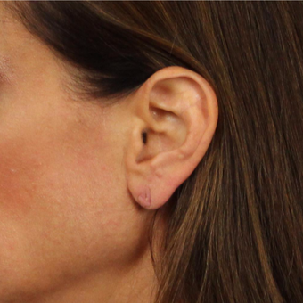 Ear Lobe Lift for recurrent droopiness of earlobes and heavy earrings before 3623440