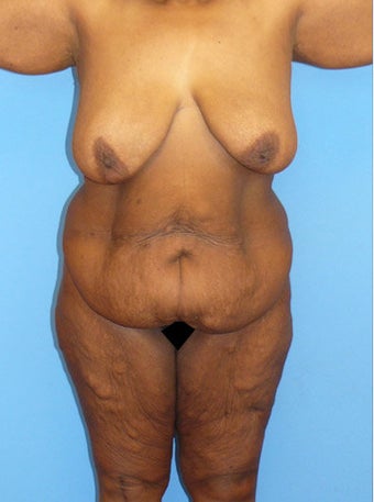 High-Definition™ Total Body Lift before 177429