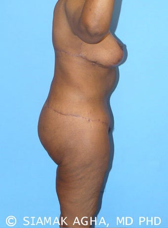 High-Definition™ Total Body Lift 177429