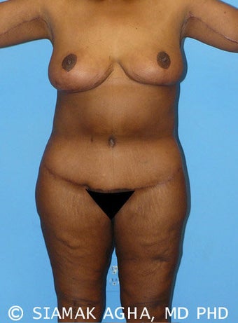 High-Definition™ Total Body Lift after 177429