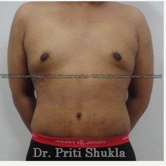 35-44 year old man treated with Tummy Tuck after 2013025