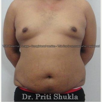 35-44 year old man treated with Tummy Tuck before 2013025
