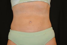 CoolSculpting to lower abdomen and hip rolls after 734625