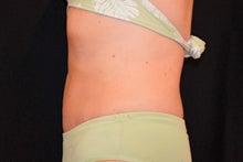 CoolSculpting to lower abdomen and hip rolls 734625