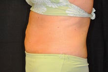 CoolSculpting to lower abdomen and hip rolls 734625