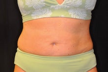 CoolSculpting to lower abdomen and hip rolls before 734625