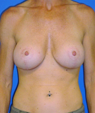 Breast Revision after 911540