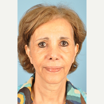 65 year old woman treated with Facelift before 3839671