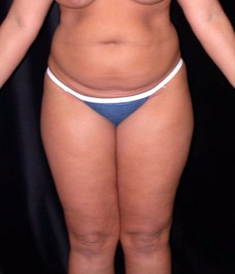 35-44 year old woman treated with SAFELipo before 3125898