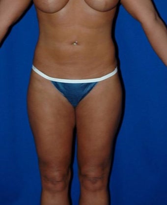 35-44 year old woman treated with SAFELipo after 3125898