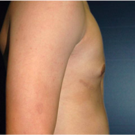 15 year old man treated with Male Breast Reduction after 3720898