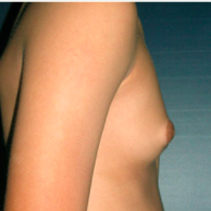 15 year old man treated with Male Breast Reduction before 3720898