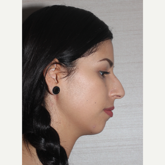 18-24 year old woman treated with Rhinoplasty before 2911160