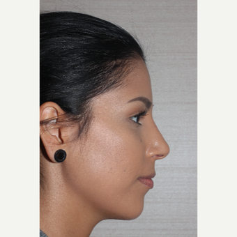18-24 year old woman treated with Rhinoplasty after 2911160