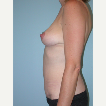 45 year old woman treated with Mommy Makeover after 3201370