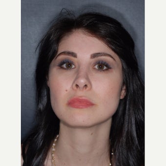 25-34 year old woman treated with Buccal Fat Removal after 2251288
