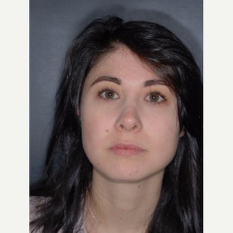 25-34 year old woman treated with Buccal Fat Removal before 2251288