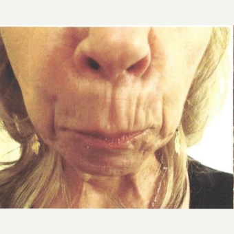 45-54 year old woman treated with Radiesse before 3744627