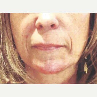 45-54 year old woman treated with Radiesse after 3744627