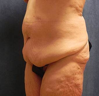 Body Lift before 1375192