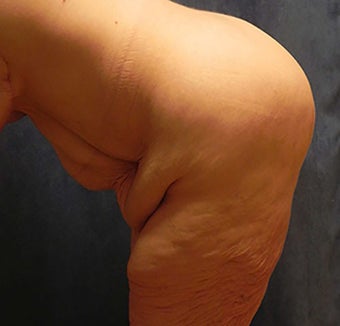Body Lift 1375192