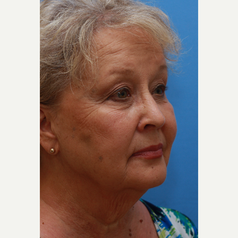 Skin Rejuvenation for improvement of wrinkles and texture before 2919142