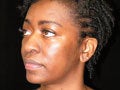 Atlanta Rhinoplasty Patient 721894
