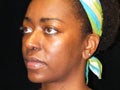 Atlanta Rhinoplasty Patient 721894