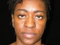 Atlanta Rhinoplasty Patient before 721894