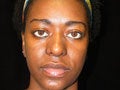 Atlanta Rhinoplasty Patient after 721894