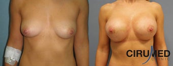 Supercharged Composite Breast Augmentation (Silicone implant plus extra shaping with fat micrografting before 1285083