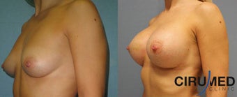 Supercharged Composite Breast Augmentation (Silicone implant plus extra shaping with fat micrografting after 1285083
