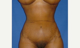 35-44 year old woman treated with Tummy Tuck after 2289356