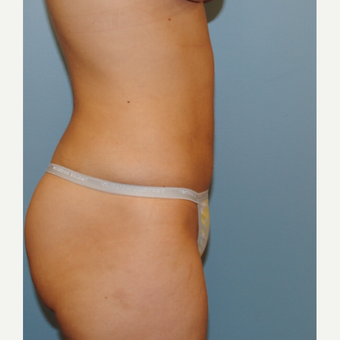 26 year old woman had liposuction of her abdomen and her love handles. after 3142644