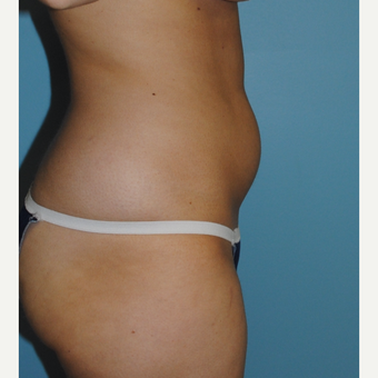 26 year old woman had liposuction of her abdomen and her love handles. before 3142644