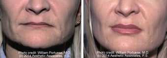 Lip Augmentation before 1385314