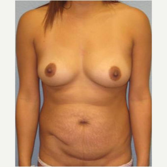 25-34 year old woman treated with Mommy Makeover before 3424055