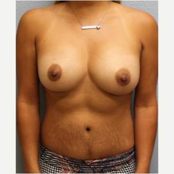 25-34 year old woman treated with Mommy Makeover after 3424055