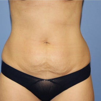 35-44 year old woman treated with Mini Tummy Tuck before 1766218