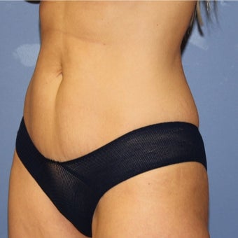35-44 year old woman treated with Mini Tummy Tuck 1766218