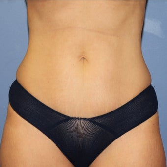 35-44 year old woman treated with Mini Tummy Tuck after 1766218