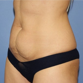 35-44 year old woman treated with Mini Tummy Tuck 1766218