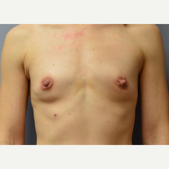 35-44 year old woman treated with Breast Augmentation before 3161487