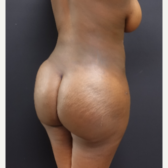 25-34 year old woman treated with Brazilian Butt Lift after 3363807