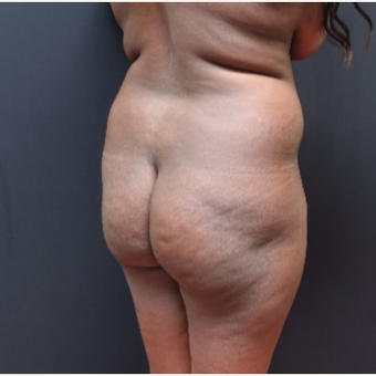 25-34 year old woman treated with Brazilian Butt Lift before 3363807
