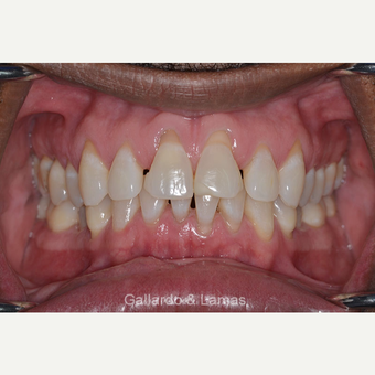 35-44 year old man treated with Gum Lift before 3075196