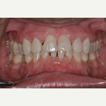 35-44 year old man treated with Gum Lift after 3075196