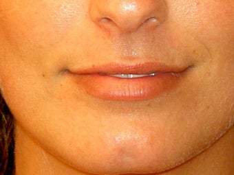 Before lip filler before 91241