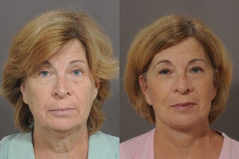 Lower Face and Neck Lift before 850299